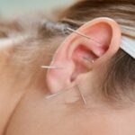 Puntos de acupuntura en la oreja y su significado