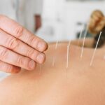 Técnicas de acupuntura: Guía completa para principiantes